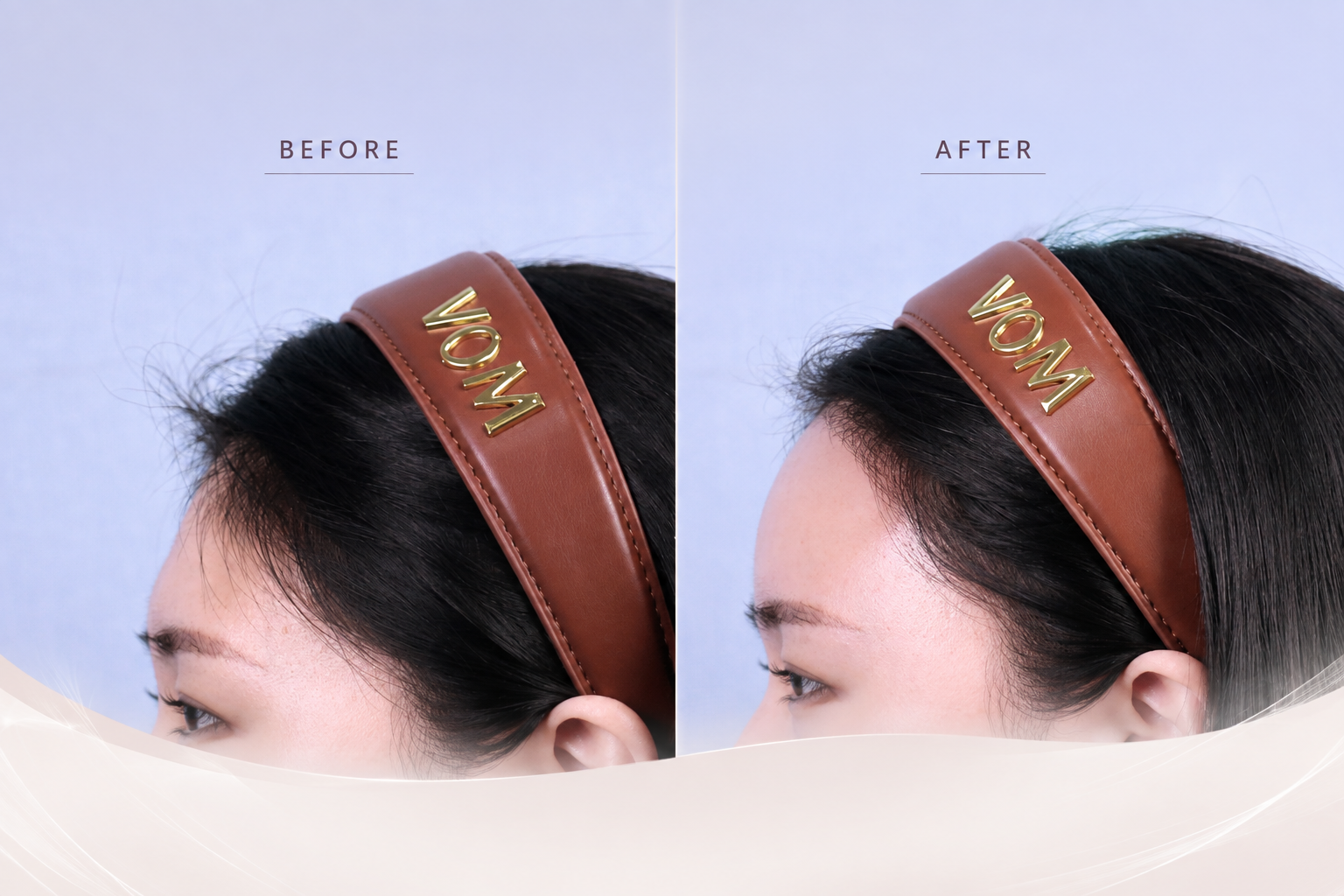 Dermal Fillers in Busan