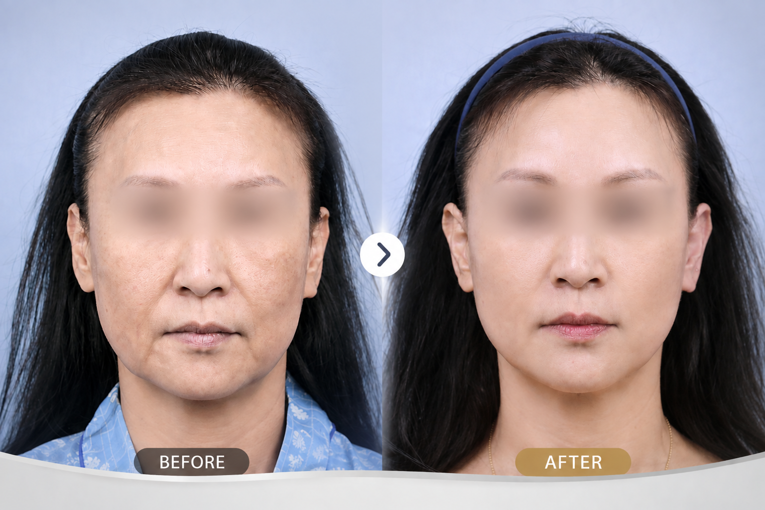 Facelift in Busan