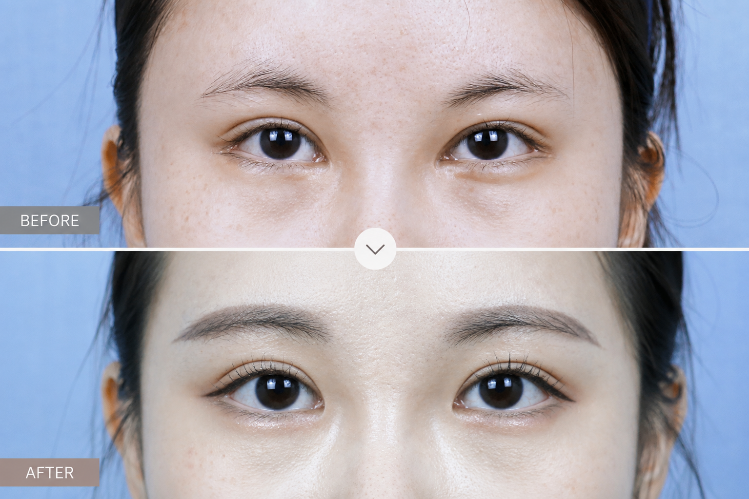 Revision Eyelid Surgery in Busan