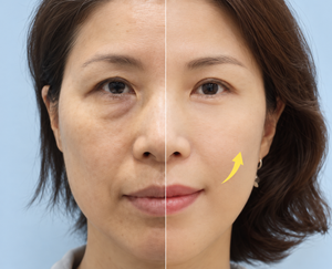 Facelift in Busan
