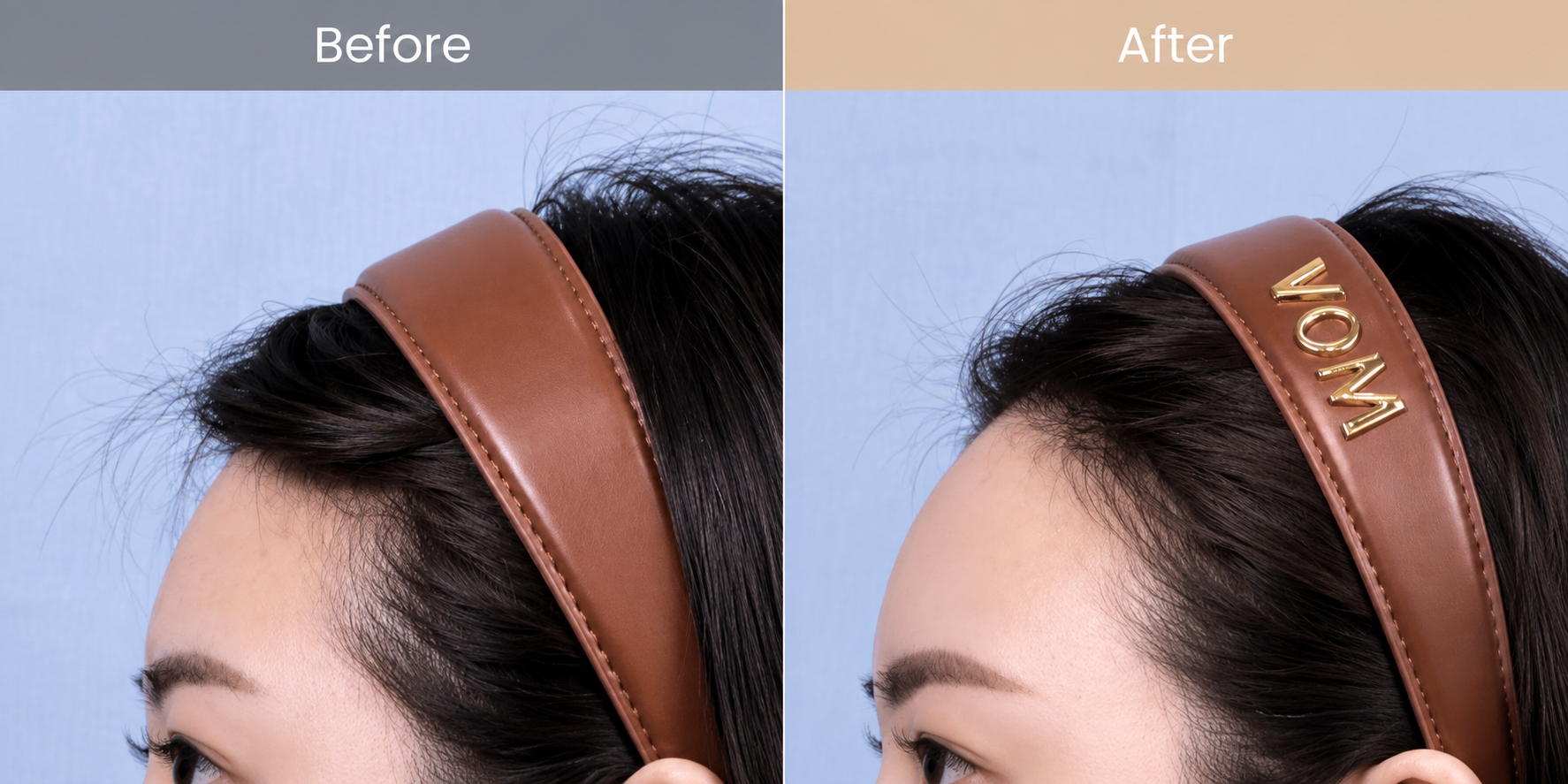 Forehead Filler in Busan