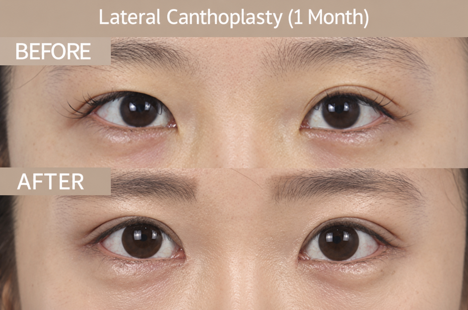 Lateral Canthoplasty in Busan