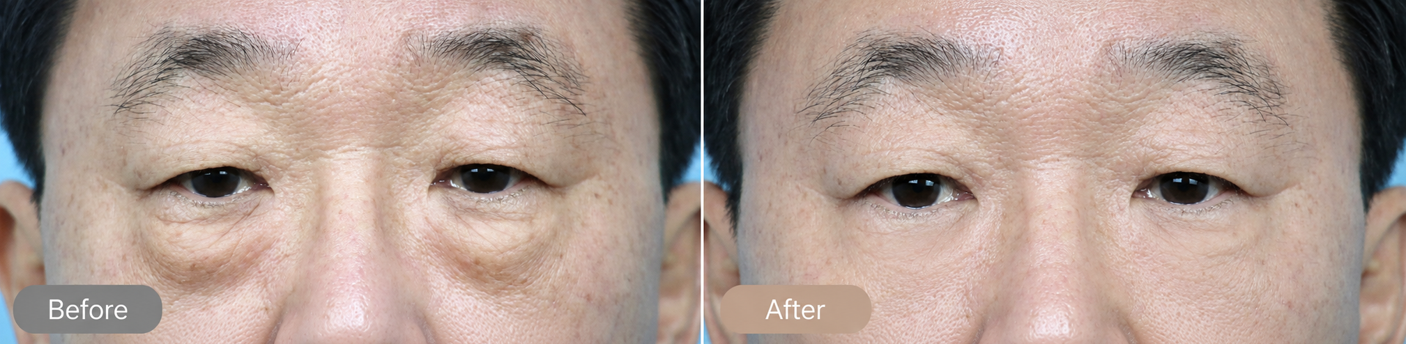 Lower Blepharoplasty in Busan