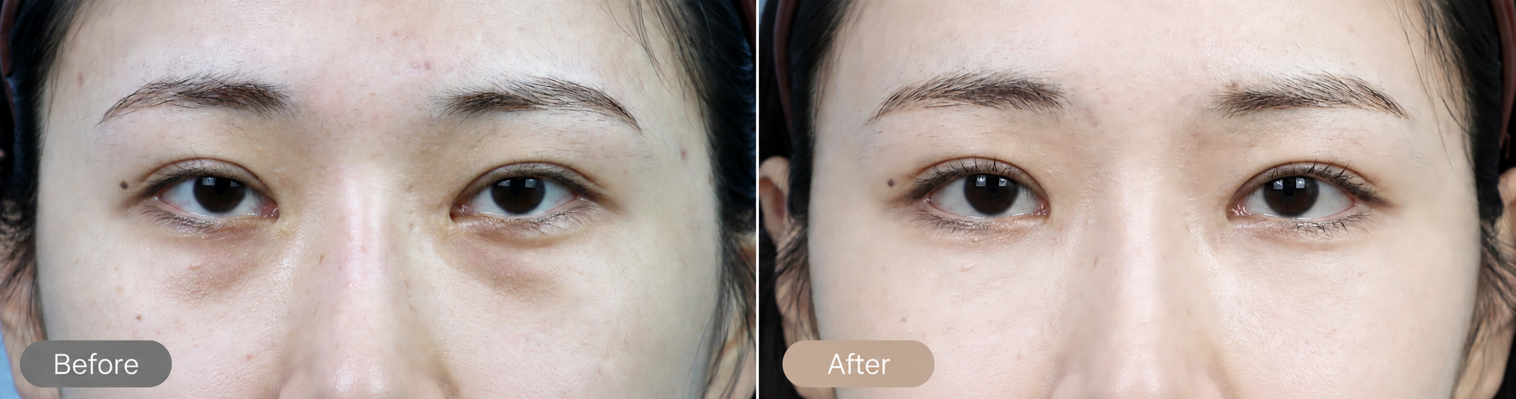 Lower Eyelid Fat Repositioning in Busan