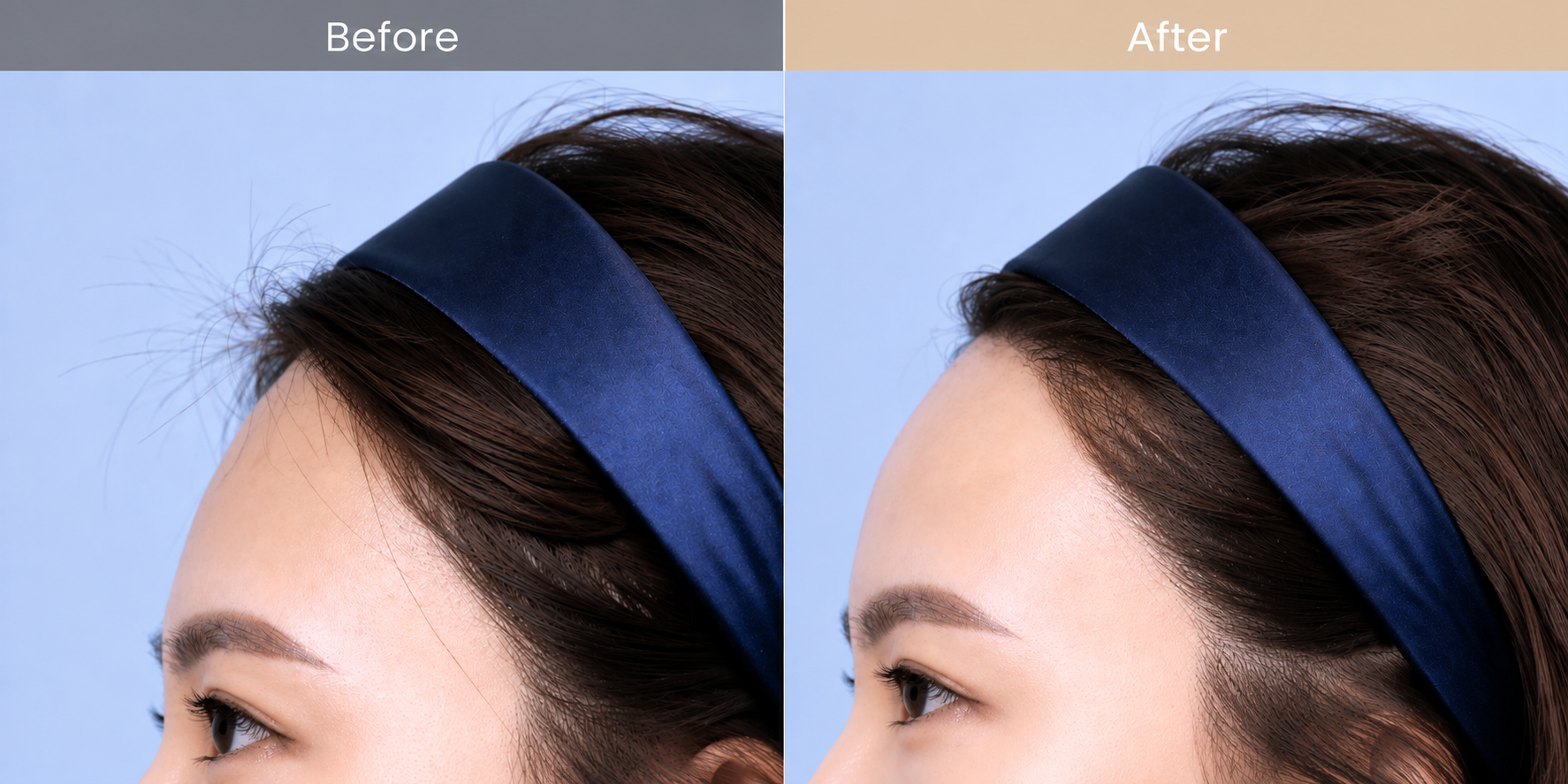 Forehead Filler in Busan