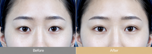 Double Eyelid Surgery in Korea