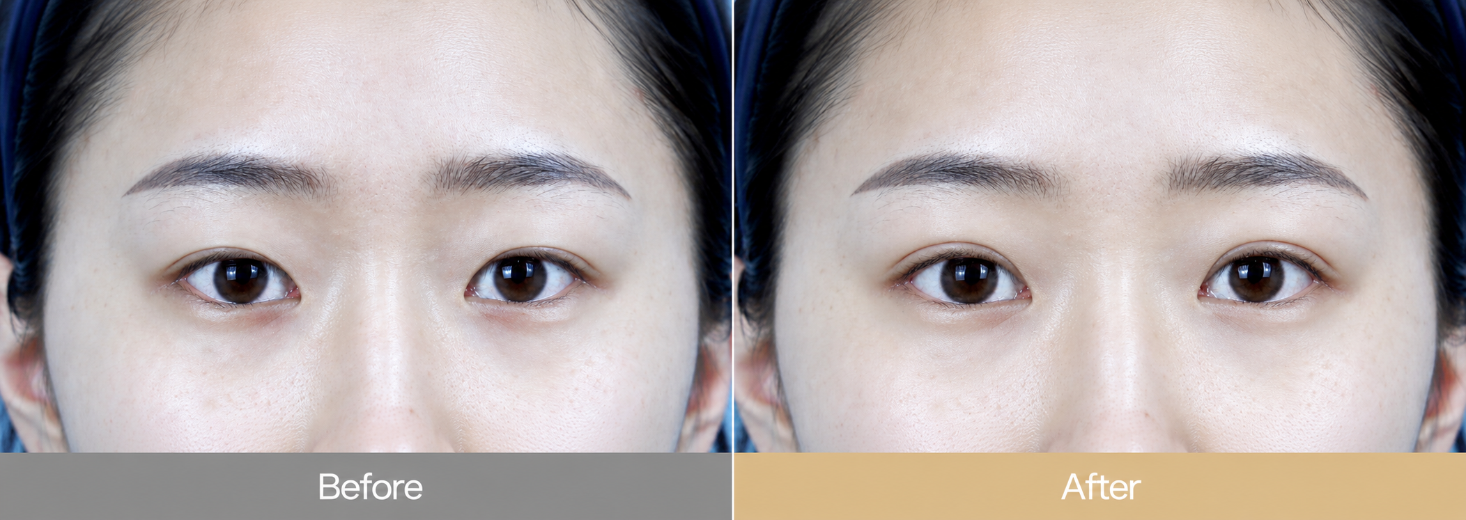 Double Eyelid Surgery in Korea
