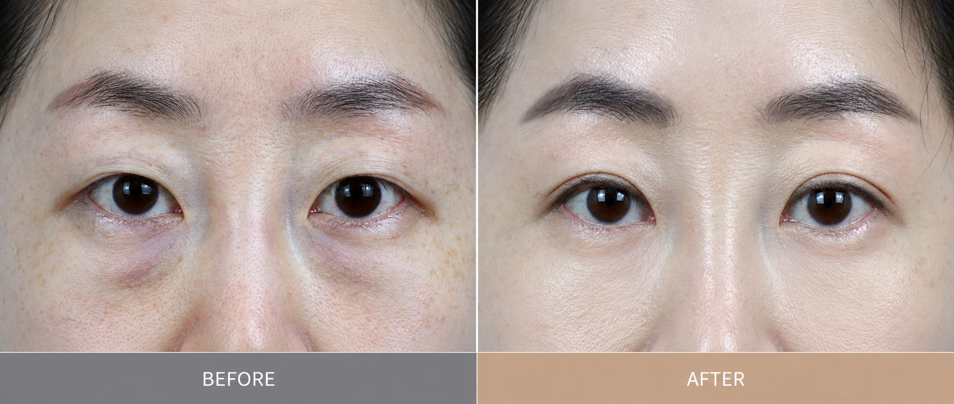 Eye Bag Surgery in Busan