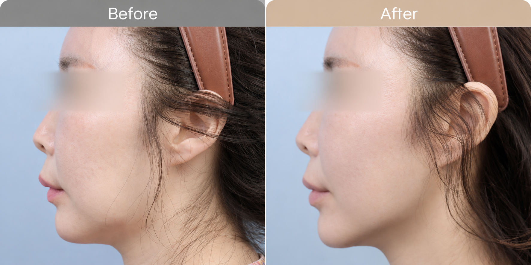 Ulthera vs Thermage